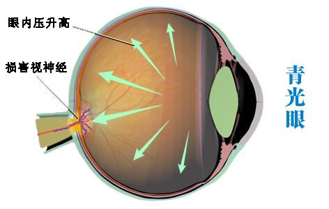 甘肅復雜疑難眼底病專科醫院 青光眼能嗎?