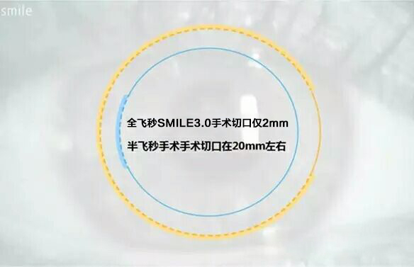 重磅發布：全飛秒SMILE3.0智能升級