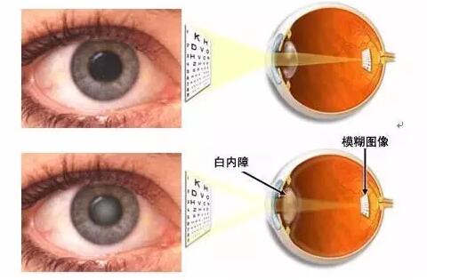 蘭州普瑞眼視光醫院成功實施德國蔡司三焦點人工晶體植入術