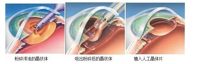 蘭州普瑞眼視光醫院成功實施德國蔡司三焦點人工晶體植入術