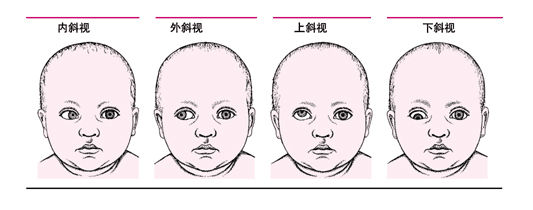 蘭州眼科專家：孩子斜弱視早發(fā)現(xiàn)早