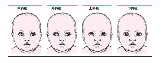 孩子有斜視做手術矯正有什么危險？