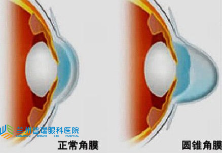 有圓錐角膜做不了近視手術怎么矯正視力