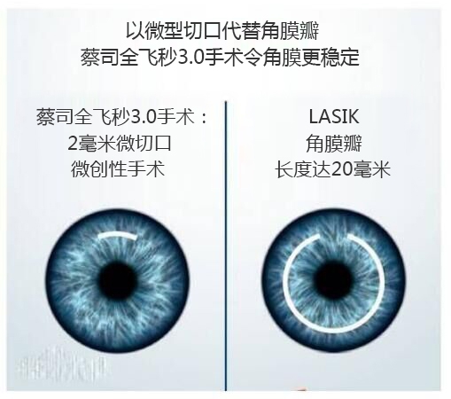 近視手術(shù)有哪幾種？你適合那種快看看