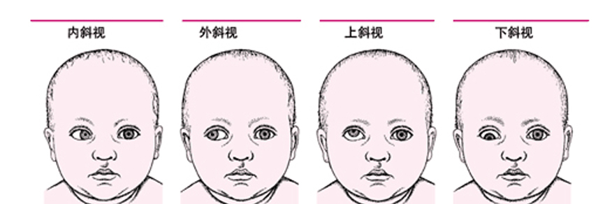 眼科醫生告訴寶媽寶爸：如何預防幼兒斜視